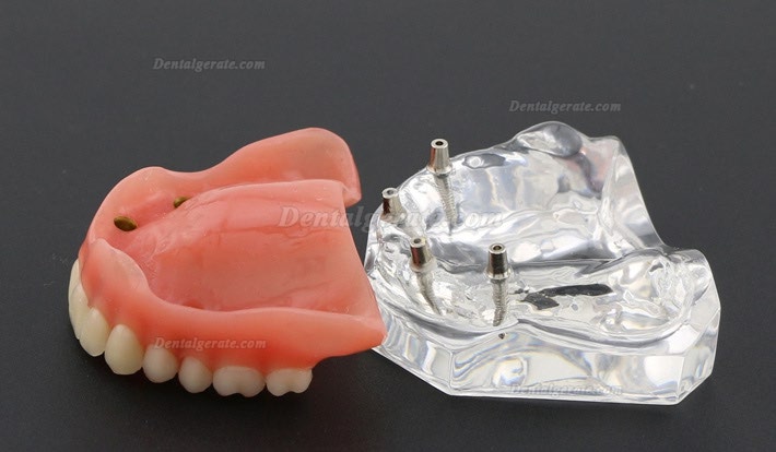 Anatomisches Modell der Zahnz&auml;hne &Uuml;berprothese Superior mit 4 Implantaten Demo Modell 6001